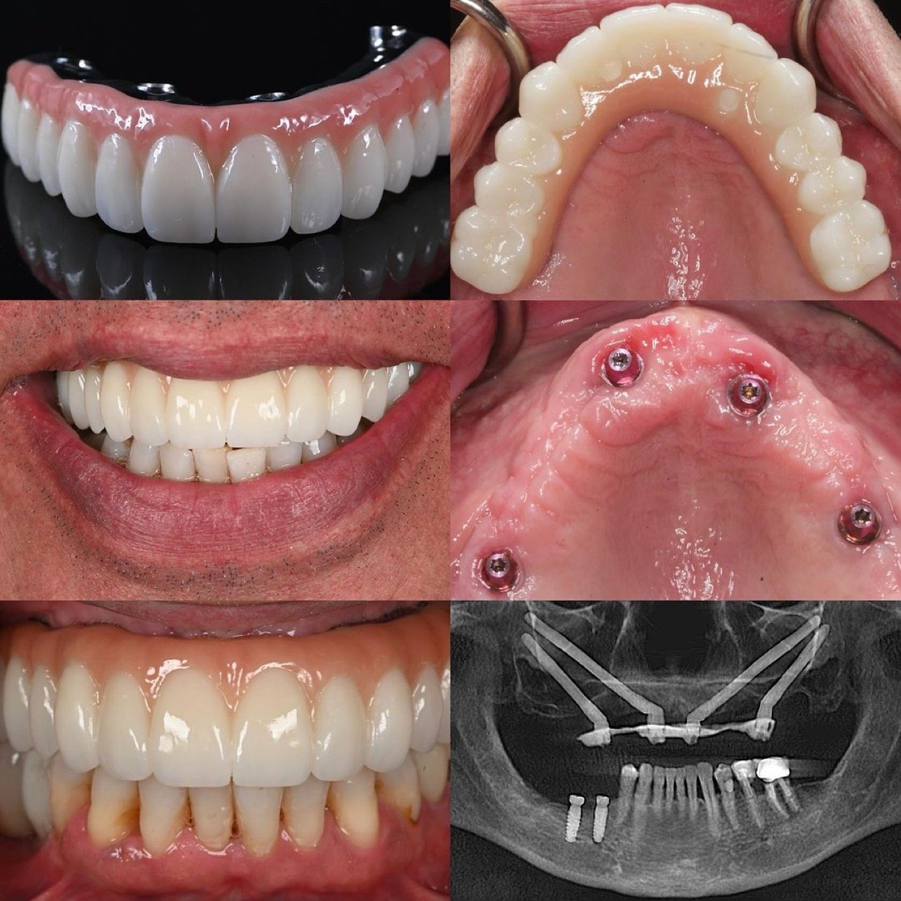 Madison NJ Prosthodontist | Dental Implants Madison NJ | All-on-X