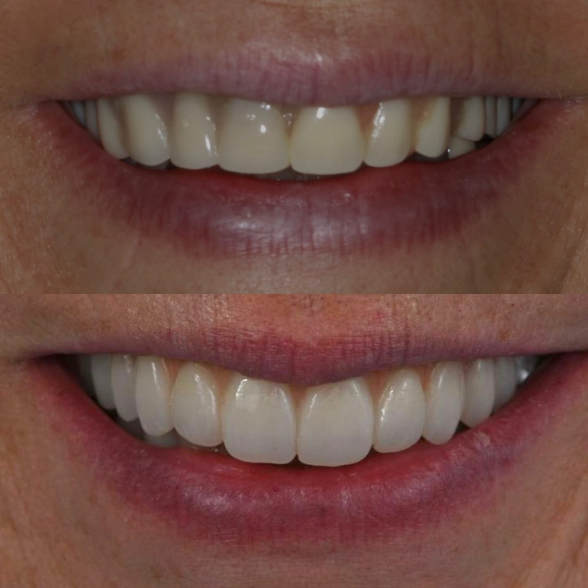 Mini X Teeth Madison NJ Prosthodontist | Dental Implants Madison NJ | All-on-X ...